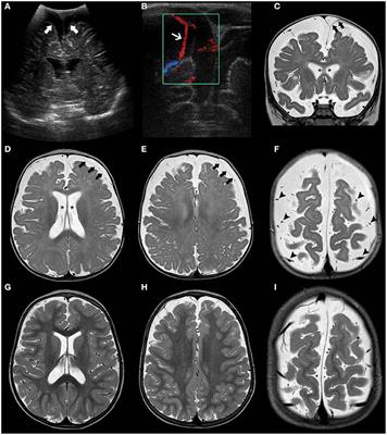 Frontiers | Diagnostic Approach to Macrocephaly in Children